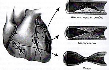 Стенокардический синдром что это такое thumbnail