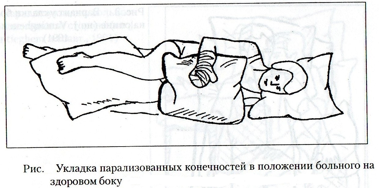 Лежал парализованным. Положение больного на здоровом боку. Положение лежа на здоровом боку. Положение пациента при параличе. Укладка парализованных конечностей лечение положением.