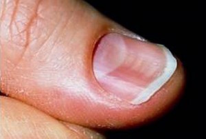 Какие болезни возникают при недостатке железа thumbnail