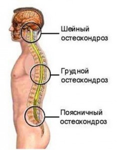 Противопоказания остеохондроза шейного отдела thumbnail