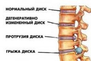 Остеохондроз поясничного отдела позвоночника с болевым синдромом лечение thumbnail