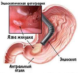 Анализ крови при язве кишечника thumbnail