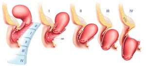 классификация выпадения матки - Опущение матки: гимнастика по Юнусову, фитотерапия, массаж