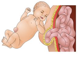 Пупочная грыжа у ребенка симптомы диета лечение thumbnail