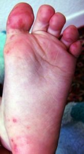 Синдром рук ног рта вирус коксаки а 16 thumbnail