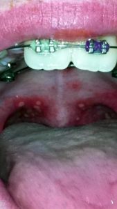 mouth sore - Вирус Коксаки: симптомы заболевания, лечение, осложнения