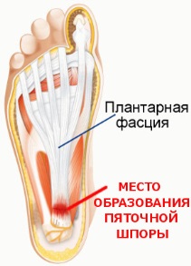 image001 - Лечение пяточной шпоры