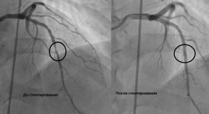image005 - Стентирование как альтернатива шунтированию