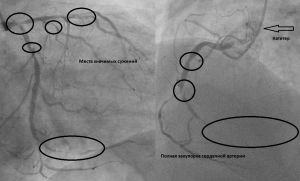 image007 - Стентирование как альтернатива шунтированию