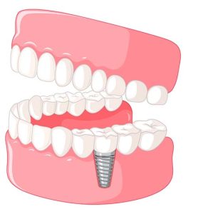 Зубные импланты: виды, показания, особенности - Азбука веры Имплант