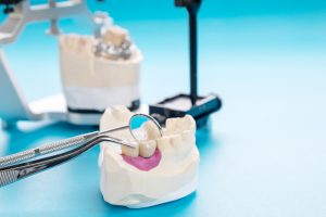 Зубные импланты: виды, показания, особенности - Азбука веры Имплант