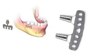 image012 1 300x176 - Зубные импланты: виды, показания, особенности