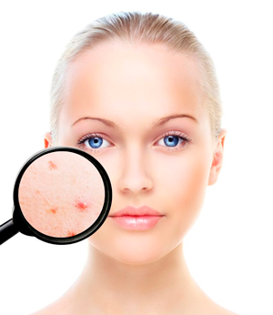 Прыщи у взрослых: причины появления акне
