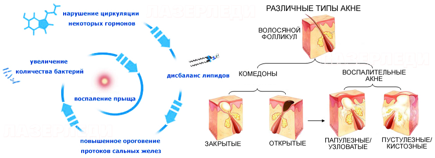 Схема лечения акне средней степени тяжести