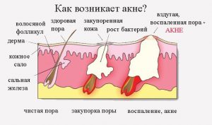 Причины появления прыщей на коже лица thumbnail