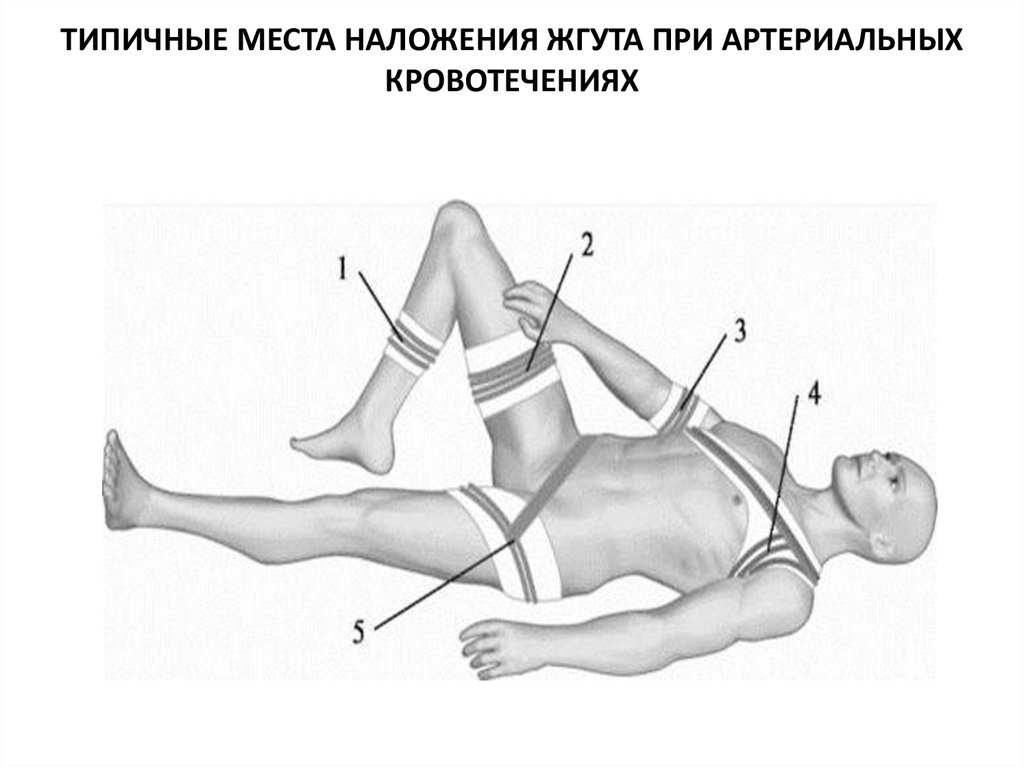 Наложение жгута при кровотечении картинка