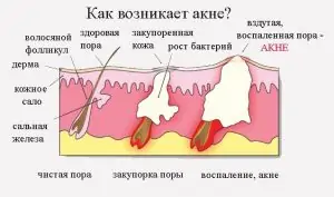 image006 1 300x177 - Прыщи у взрослых: причины появления акне